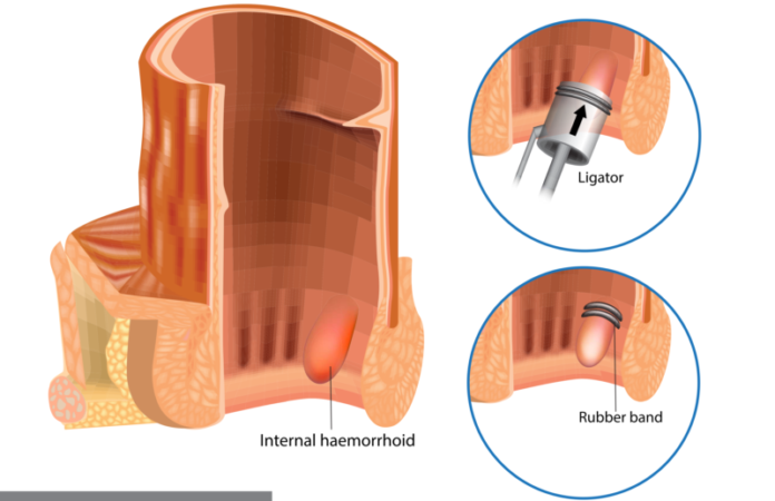 Internal Haemorrhoid Treatment